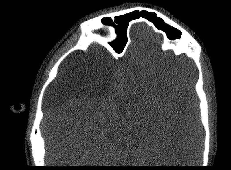 Arachnoid cyst- extremely large (Radiopaedia 68741-78450 Axial bone window 41).jpg