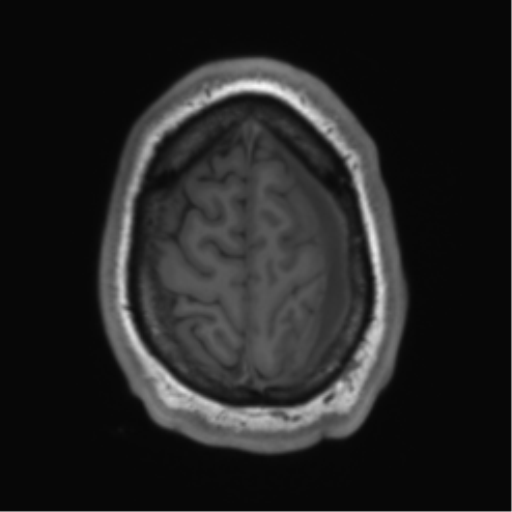 File:Arachnoid cyst with subdural hematoma (Radiopaedia 85892-101743 Axial T1 74).png