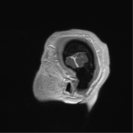 Arachnoid cyst with subdural hematoma (Radiopaedia 85892-101743 Sagittal T1 C+ 86).png