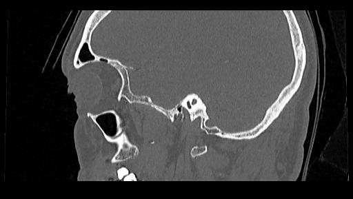 Arcuate foramen (Radiopaedia 89833-106944 Sagittal bone window 118).jpg