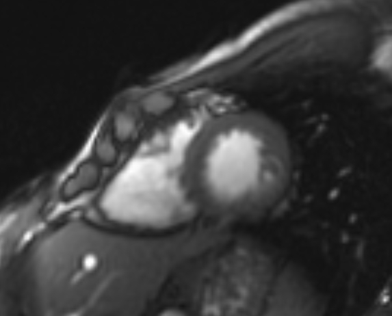 Arrhythmogenic right ventricular cardiomyopathy (Radiopaedia 69564-79464 short axis cine 84).jpg