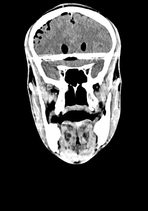 Arrow injury to the brain (Radiopaedia 72101-82607 Coronal non-contrast 30).jpg