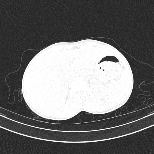 Arteria lusoria (Radiopaedia 88528-105192 Axial lung window 62).jpg