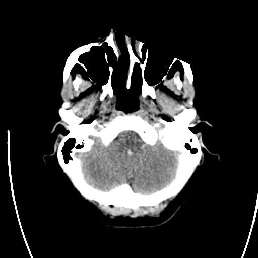 File:Arteriovenous malformation (cerebral) (Radiopaedia 40070-42579 Axial non-contrast 6).png