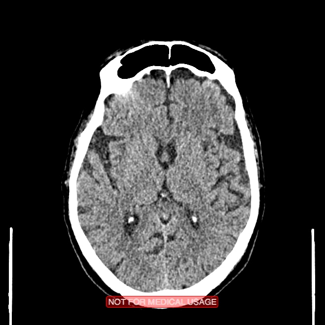 Artery of Percheron infarction (Radiopaedia 28679-28967 Axial non-contrast 62).jpg