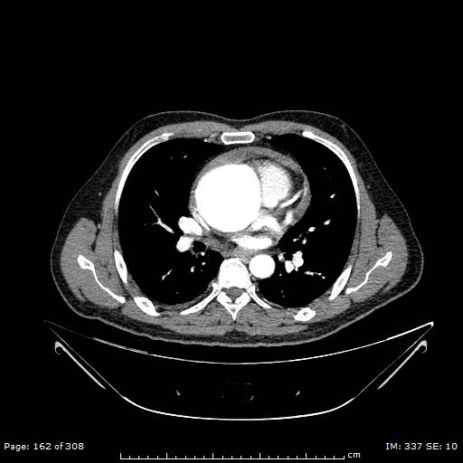 Ascending aortic aneurysm (Radiopaedia 50086-55404 A 41).jpg