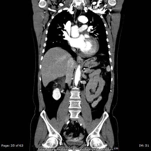 Ascending aortic aneurysm (Radiopaedia 50086-55404 B 35).jpg