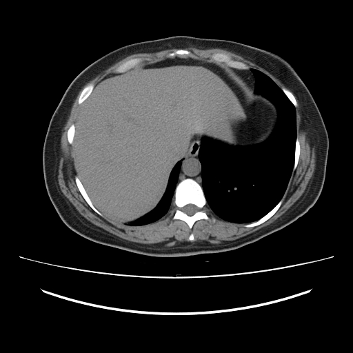 Ascending retrocecal appendicitis with liver abscesses (Radiopaedia 60066-67615 Axial non-contrast 12).jpg