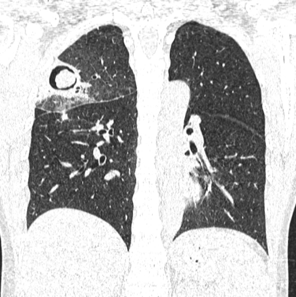 File:Aspergilloma (Radiopaedia 26223-26347 Coronal lung window 34).jpg