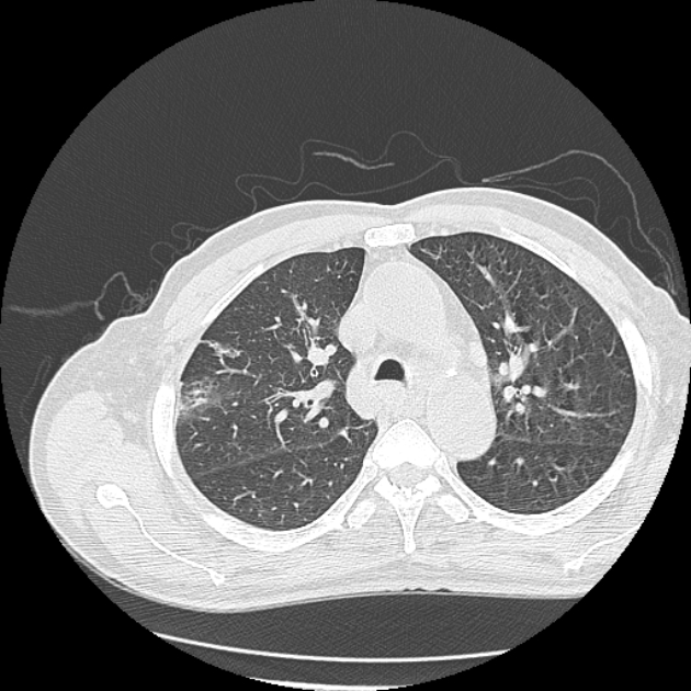 Aspergilloma (Radiopaedia 44592-48327 Axial lung window 26).jpg