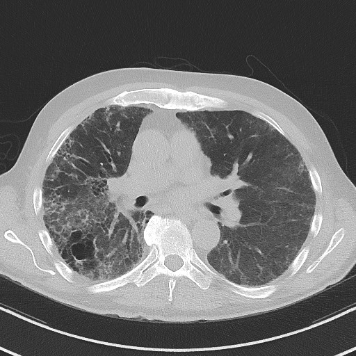 Aspergilloma on background pulmonary fibrosis (Radiopaedia 60942-68757 A 28).jpg