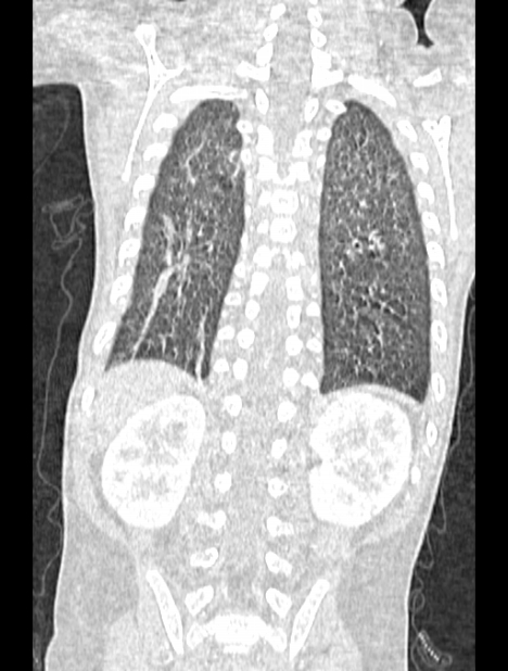 Asplenia syndrome (Radiopaedia 73083-83792 Coronal lung window 112).jpg