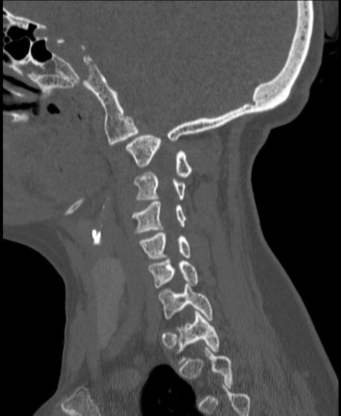 Atlanto-occipital assimilation with basilar invagination (Radiopaedia 70122-80188 Sagittal bone window 26).jpg