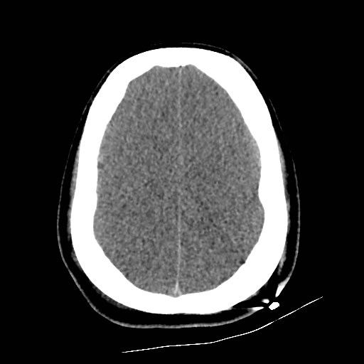 File:Atlanto-occipital dislocation (Radiopaedia 44648-48412 Axial non-contrast 43).jpg