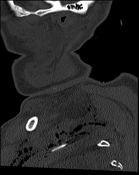 Atlanto-occipital dissociation - Traynelis type 1 (Radiopaedia 87570-103948 Sagittal bone window 13).jpg