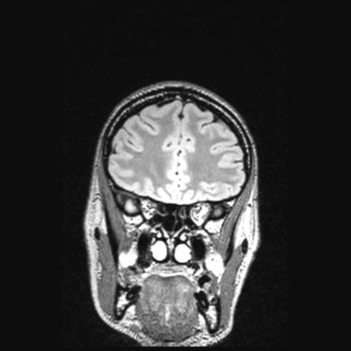 Atretic encephalocoele with inferior vermis hypoplasia (Radiopaedia 30443-31108 Coronal FLAIR 136).jpg