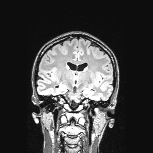 Atretic encephalocoele with inferior vermis hypoplasia (Radiopaedia 30443-31108 Coronal FLAIR 96).jpg