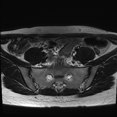 File:Atypical deep infiltrating endometriosis (Radiopaedia 44470-48125 Axial T2 2).jpg