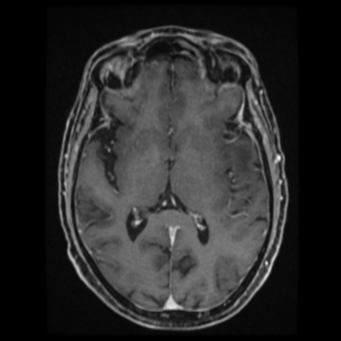 Atypical meningioma (Radiopaedia 45535-49629 Axial T1 C+ 38).jpg