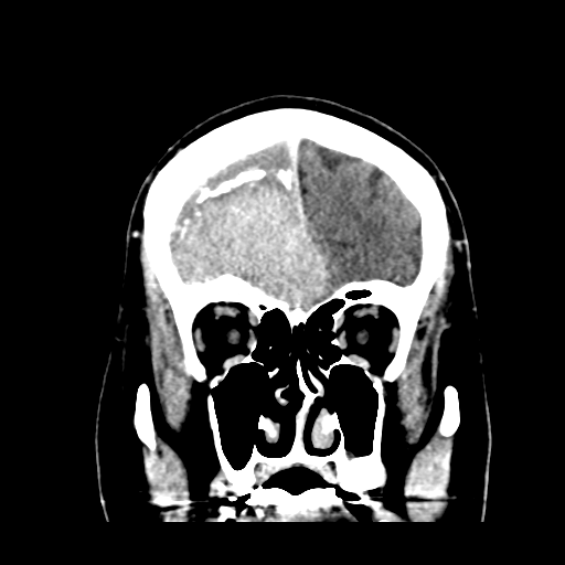 Atypical meningioma (WHO grade II) with brain invasion (Radiopaedia 57767-64728 Coronal C+ 15).png