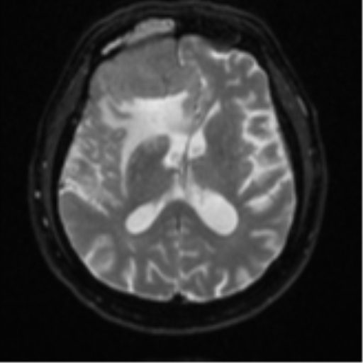 Atypical meningioma (WHO grade II) with brain invasion (Radiopaedia 57767-64729 Axial DWI 16).png