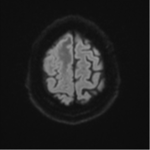 Atypical meningioma (WHO grade II) with brain invasion (Radiopaedia 57767-64729 Axial DWI 56).png