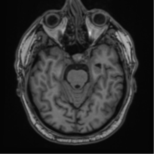 File:Atypical meningioma (WHO grade II) with brain invasion (Radiopaedia 57767-64729 Axial T1 16).png