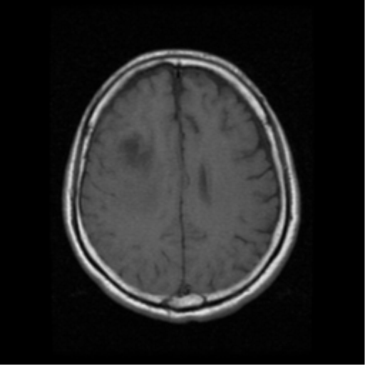 File:Atypical meningioma (WHO grade II) with osseous invasion (Radiopaedia 53654-59716 Axial T1 15).png