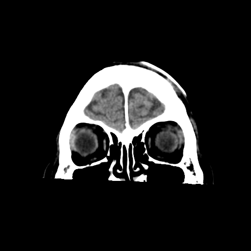 Atypical meningioma with skull invasion (Radiopaedia 34357-35649 Coronal non-contrast 12).png