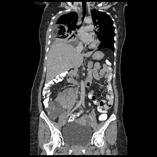 File:Atypical retroperitoneal lymphocoeles with large leiomyoma of uterus (Radiopaedia 32084-33024 B 11).jpg