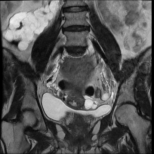 File:Atypical retroperitoneal lymphocoeles with large leiomyoma of uterus (Radiopaedia 32084-33027 Coronal T2 21).jpg