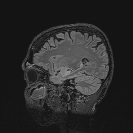 Autoimmune limbic encephalitis (Radiopaedia 30363-31005 Sagittal FLAIR 107).jpg
