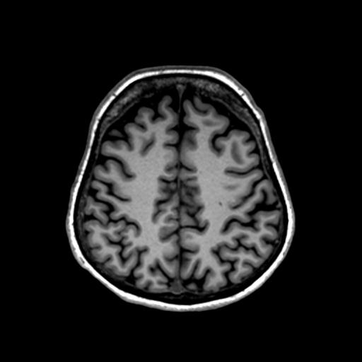 Autoimmune limbic encephalitis (Radiopaedia 30363-31005 T1 Axial 1mm 112).jpg