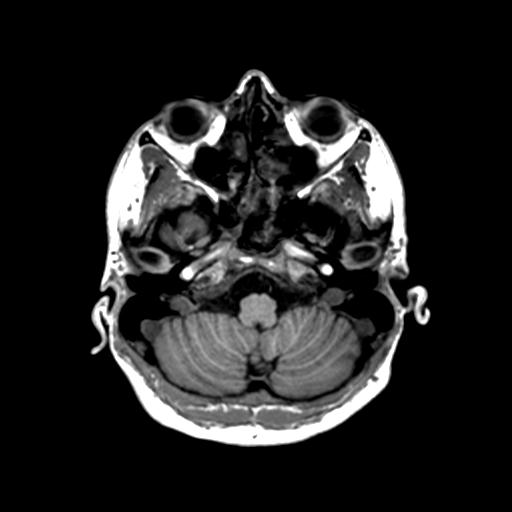 Autoimmune limbic encephalitis (Radiopaedia 30363-31005 T1 Axial 1mm 33).jpg