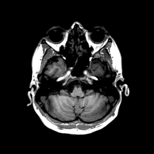 Autoimmune limbic encephalitis (Radiopaedia 30363-31005 T1 Axial 1mm 37).jpg