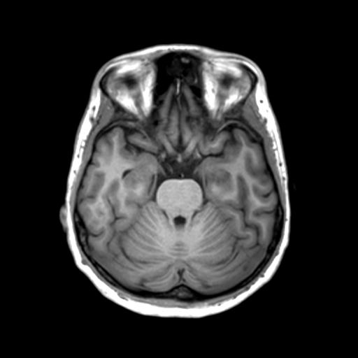 Autoimmune limbic encephalitis (Radiopaedia 30363-31005 T1 Axial 3mm 18).jpg