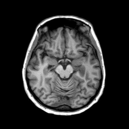 Autoimmune limbic encephalitis (Radiopaedia 30363-31005 T1 Axial 3mm 21).jpg