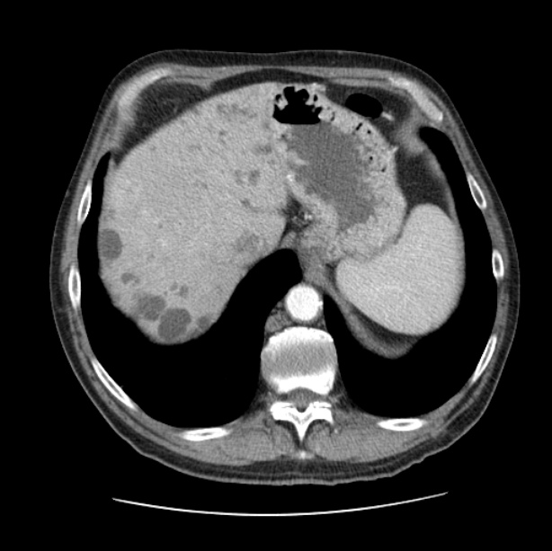 Autosomal dominant polycystic kidney disease (Radiopaedia 27851-28094 B 52).jpg