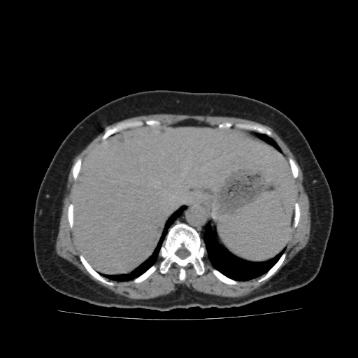Autosomal dominant polycystic kidney disease (Radiopaedia 38189-40194 Axial C+ delayed 4).jpg