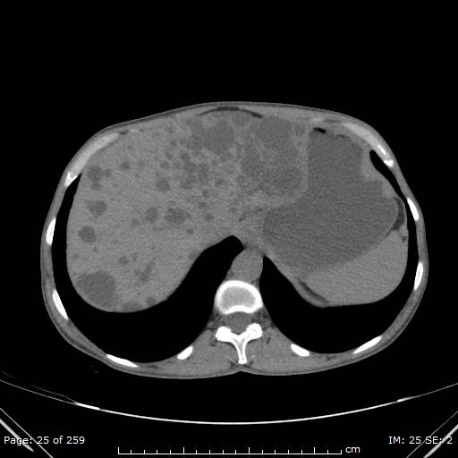 File:Autosomal dominant polycystic kidney disease (Radiopaedia 44122-47684 Axial 77).jpg