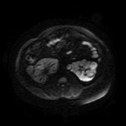 File:Autosomal dominant polycystic kidney disease (Radiopaedia 50259-55611 Axial DWI 99).jpg