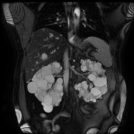 File:Autosomal dominant polycystic kidney disease (Radiopaedia 50259-55611 Coronal FIESTA 19).jpg
