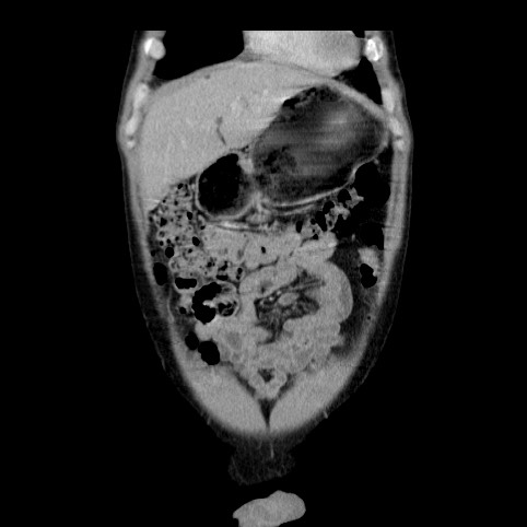 Autosomal dominant polycystic kidney disease (Radiopaedia 66349-75582 A 5).jpg