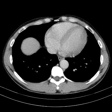 Autosomal dominant polycystic kidney disease (Radiopaedia 66349-75582 B 1).jpg