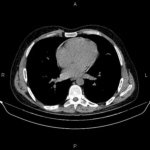 Autosomal dominant polycystic kidney disease (Radiopaedia 87830-104287 Axial non-contrast 3).jpg