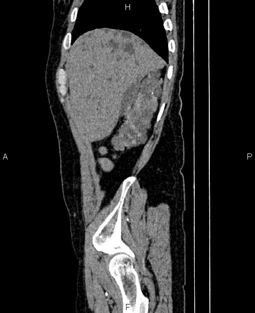 Autosomal dominant polycystic kidney disease (Radiopaedia 87830-104287 C 10).jpg