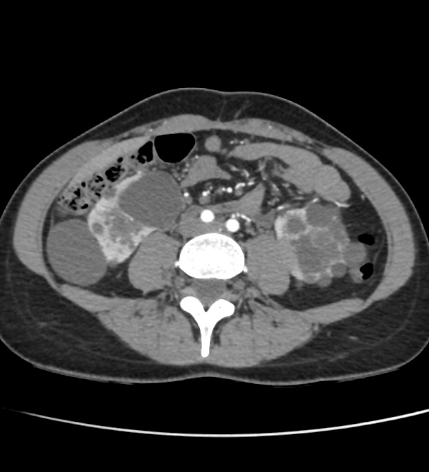 Autosomal dominant polycystic kidney disease - early onset (Radiopaedia 40734-43387 B 45).jpg