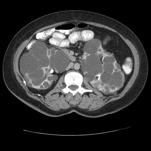Autosomal dominant polycystic kidney disease with hepatic involvement (Radiopaedia 32693-33662 C 37).jpg