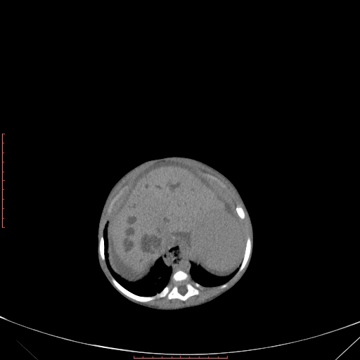 Autosomal recessive polycystic kidney disease associated with Caroli disease (Radiopaedia 61932-69984 Axial non-contrast 108).jpg