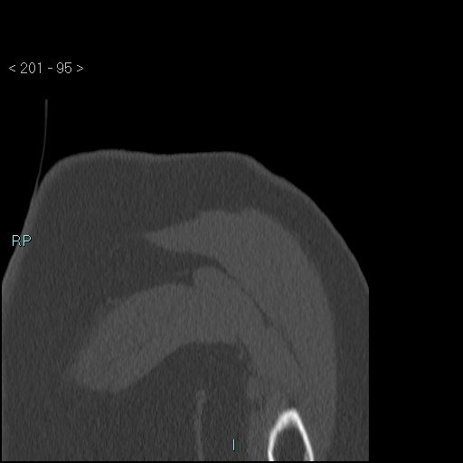 Avascular necrosis of the shoulder - Cruess stage I (Radiopaedia 77674-89887 Coronal bone window 94).jpg